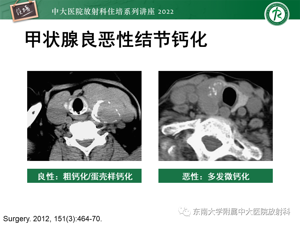 影像PPT - 【PPT】甲状腺肿瘤及肿瘤样病变影像诊断与评估-35