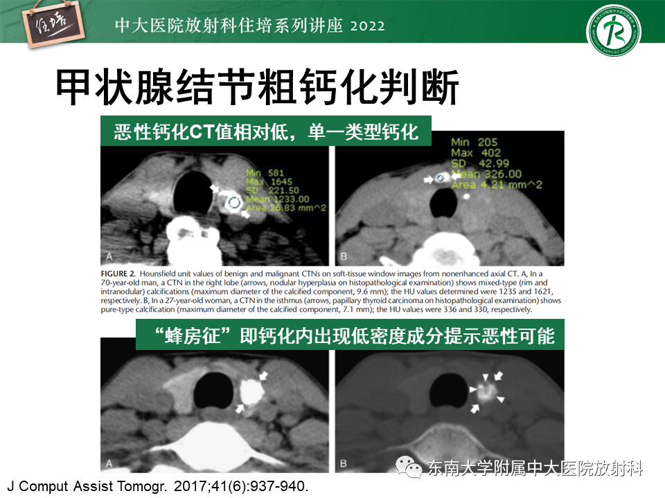 影像PPT - 【PPT】甲状腺肿瘤及肿瘤样病变影像诊断与评估-36