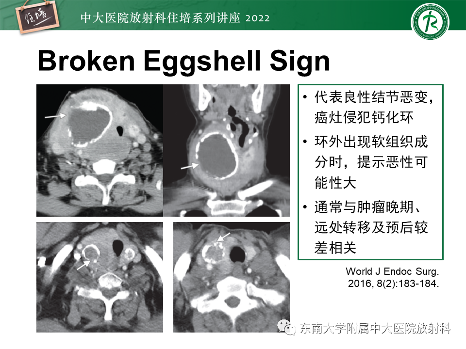 影像PPT - 【PPT】甲状腺肿瘤及肿瘤样病变影像诊断与评估-37