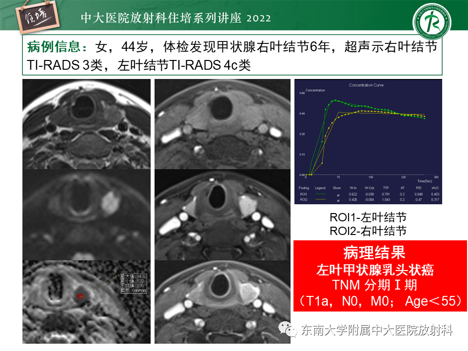 影像PPT - 【PPT】甲状腺肿瘤及肿瘤样病变影像诊断与评估-41