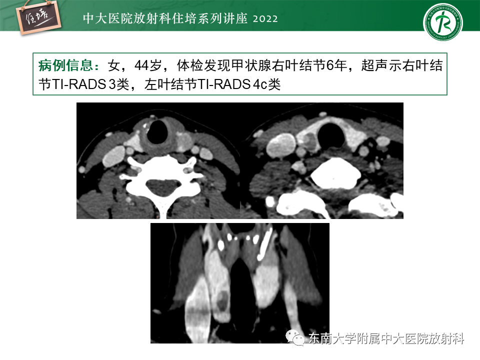 影像PPT - 【PPT】甲状腺肿瘤及肿瘤样病变影像诊断与评估-42