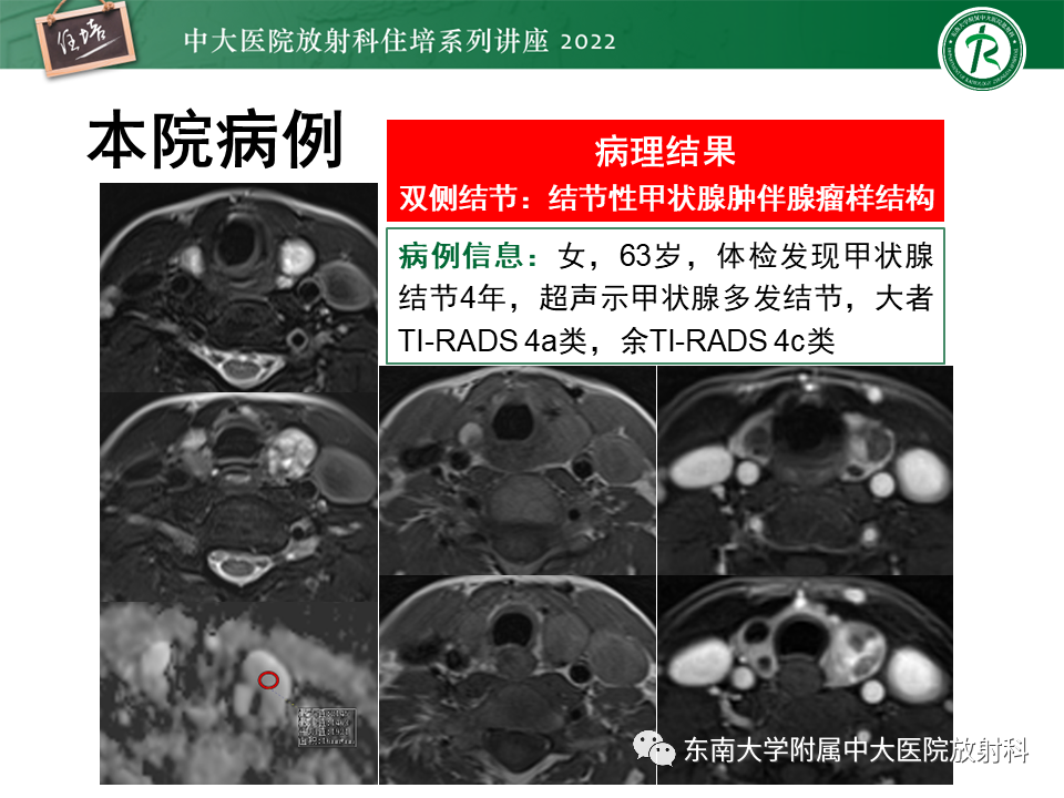 影像PPT - 【PPT】甲状腺肿瘤及肿瘤样病变影像诊断与评估-48