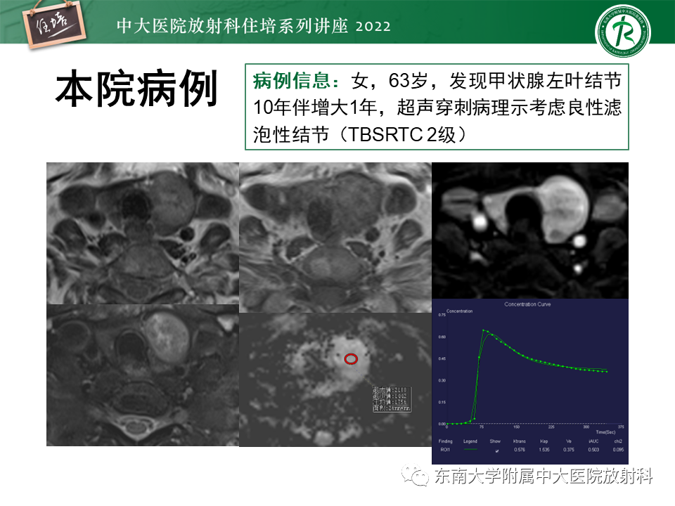 影像PPT - 【PPT】甲状腺肿瘤及肿瘤样病变影像诊断与评估-51