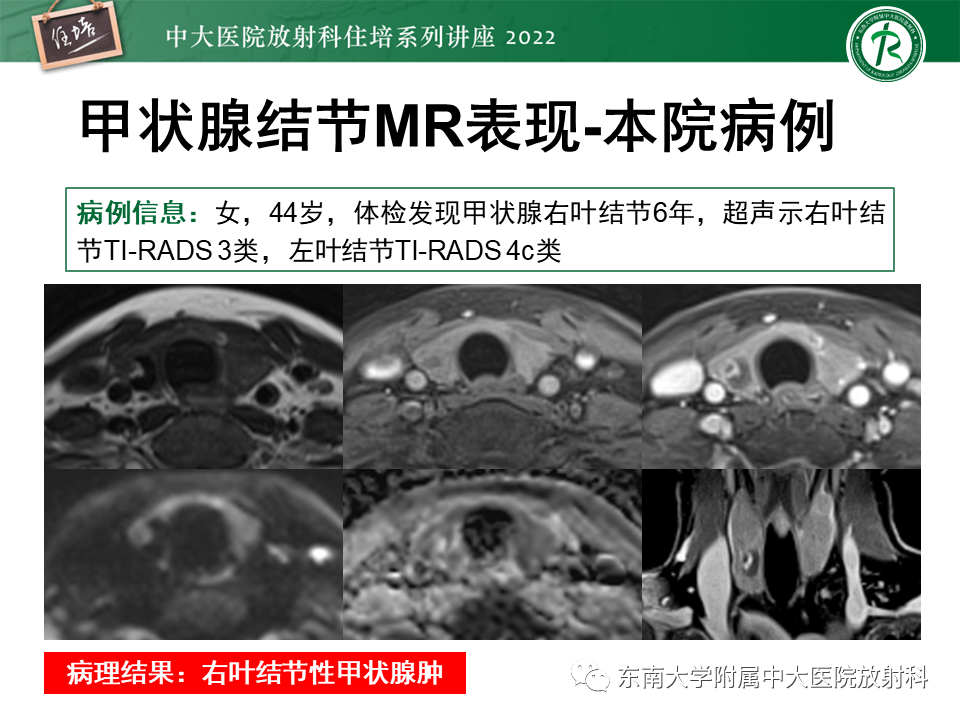 影像PPT - 【PPT】甲状腺肿瘤及肿瘤样病变影像诊断与评估-40
