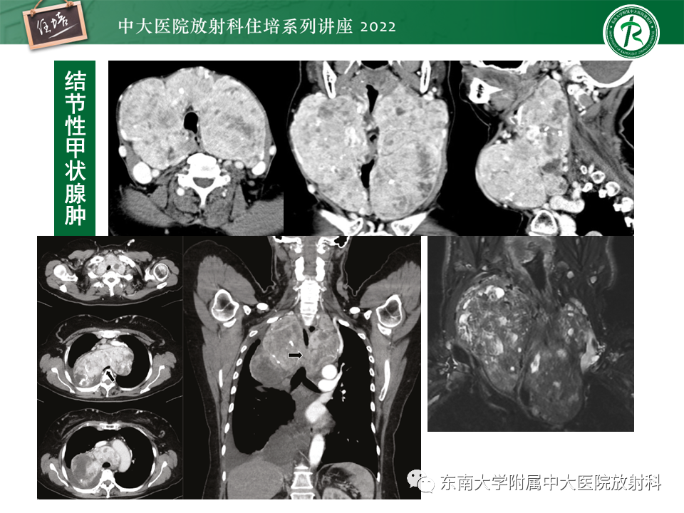影像PPT - 【PPT】甲状腺肿瘤及肿瘤样病变影像诊断与评估-46