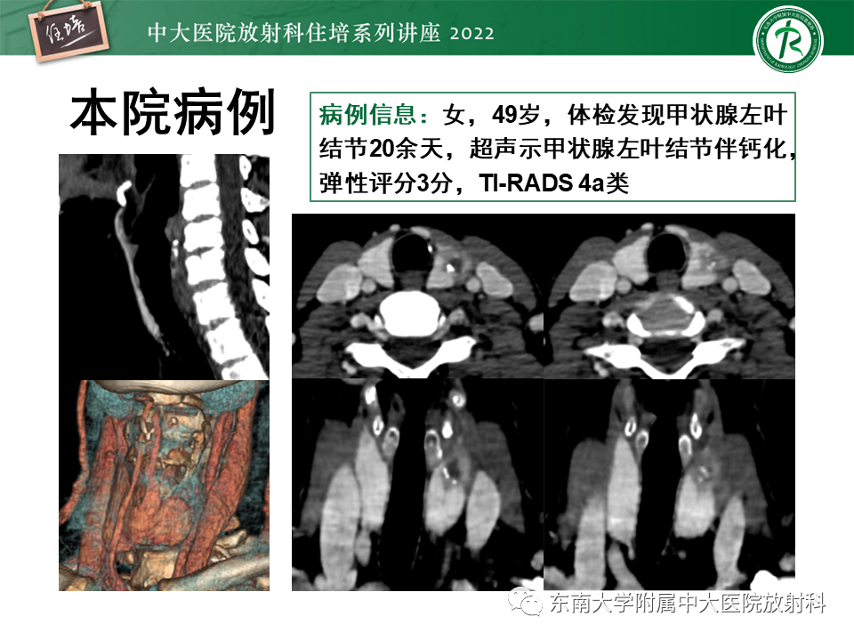 影像PPT - 【PPT】甲状腺肿瘤及肿瘤样病变影像诊断与评估-57