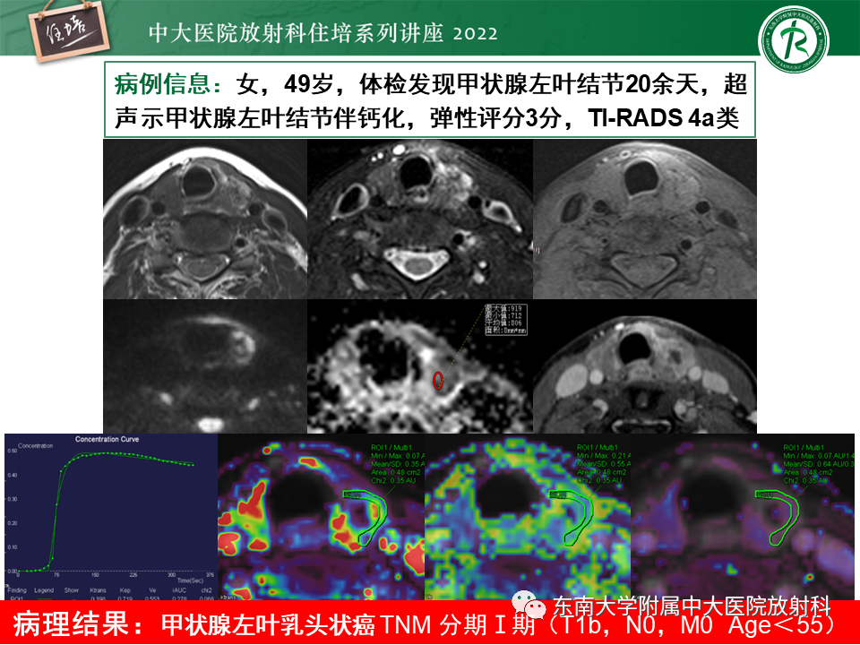 影像PPT - 【PPT】甲状腺肿瘤及肿瘤样病变影像诊断与评估-58