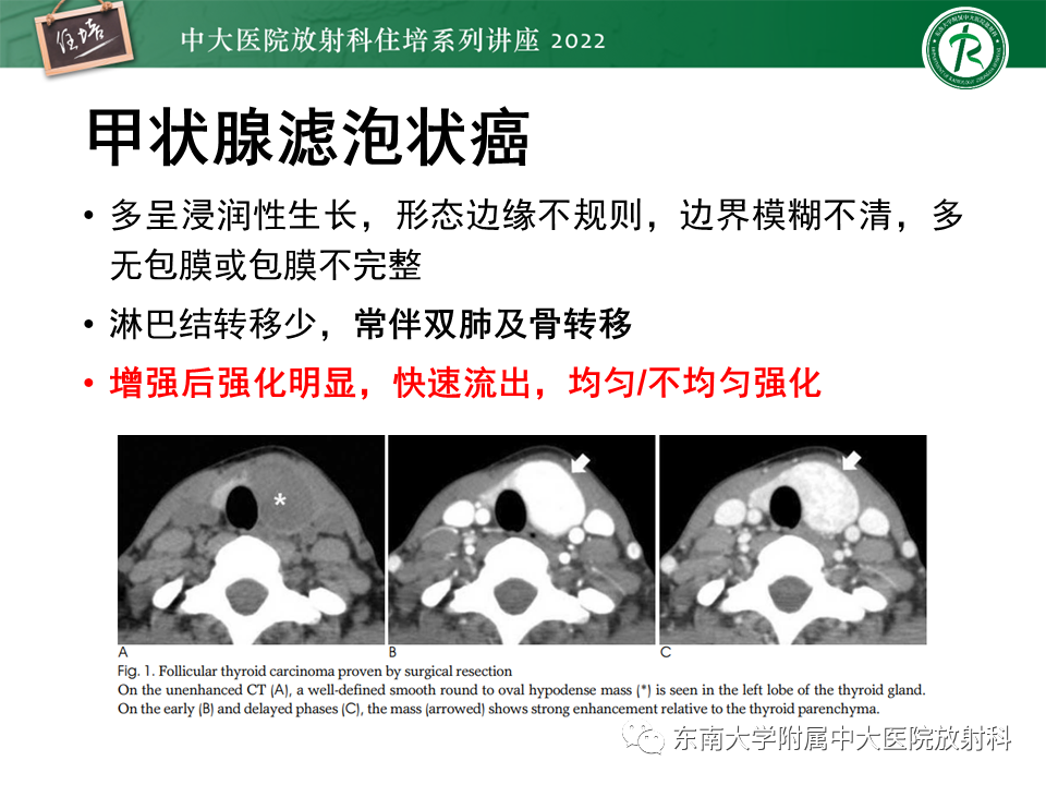影像PPT - 【PPT】甲状腺肿瘤及肿瘤样病变影像诊断与评估-63