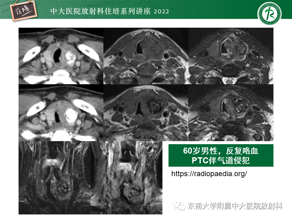 影像PPT - 【PPT】甲状腺肿瘤及肿瘤样病变影像诊断与评估-59