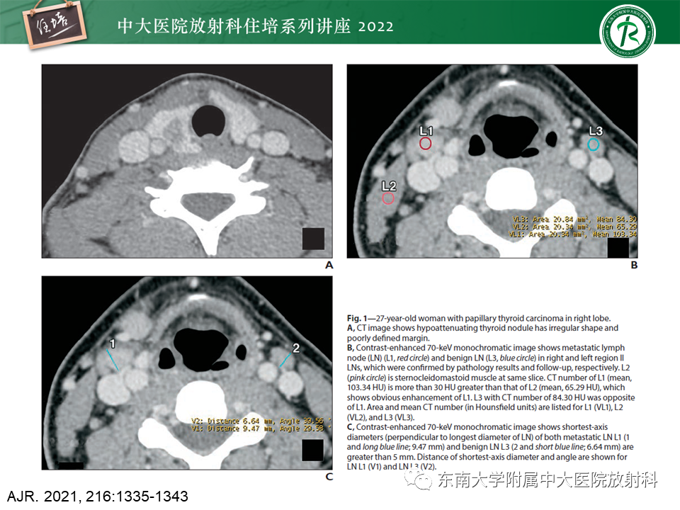 影像PPT - 【PPT】甲状腺肿瘤及肿瘤样病变影像诊断与评估-62