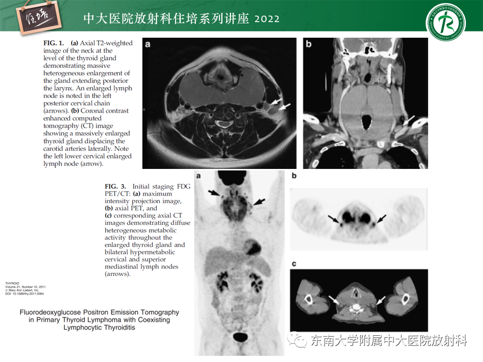 影像PPT - 【PPT】甲状腺肿瘤及肿瘤样病变影像诊断与评估-67