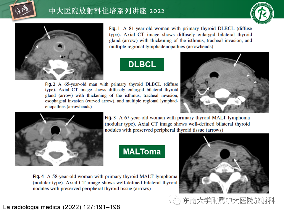 影像PPT - 【PPT】甲状腺肿瘤及肿瘤样病变影像诊断与评估-68