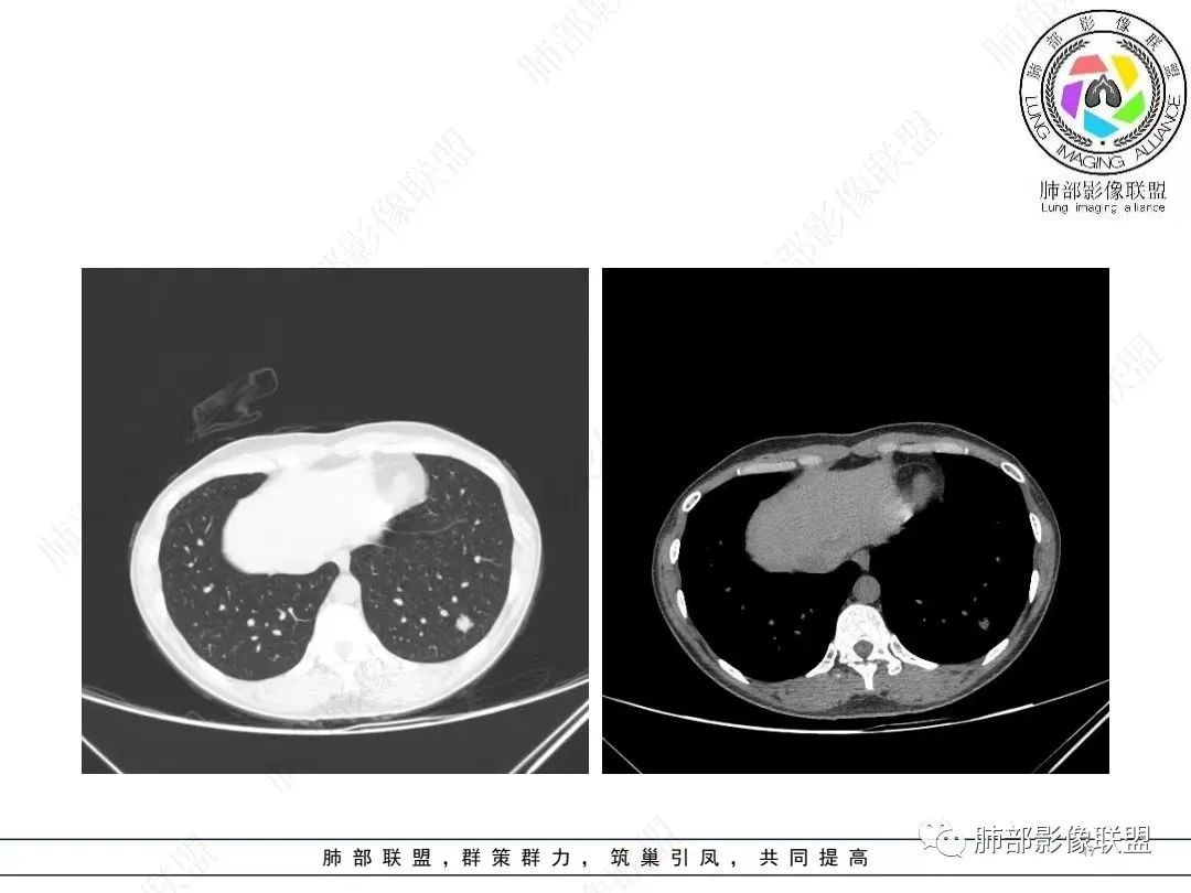 影像PPT - 【病例】年轻女性的肺结节-17 影像PPT - 【病例】年轻女性的肺结节-17