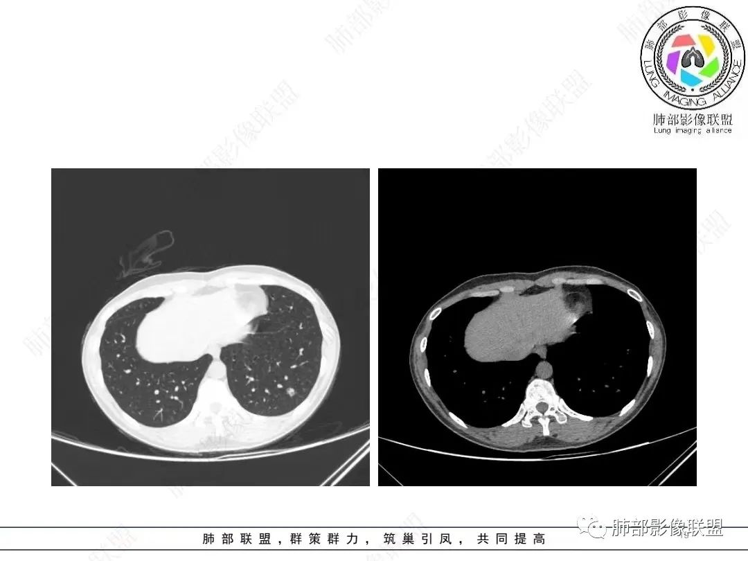 影像PPT - 【病例】年轻女性的肺结节-19 影像PPT - 【病例】年轻女性的肺结节-19