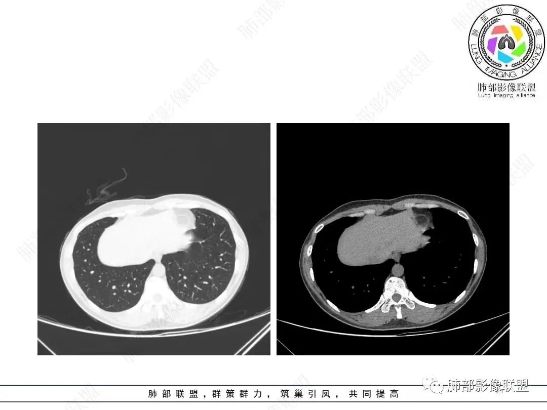 影像PPT - 【病例】年轻女性的肺结节-21 影像PPT - 【病例】年轻女性的肺结节-21