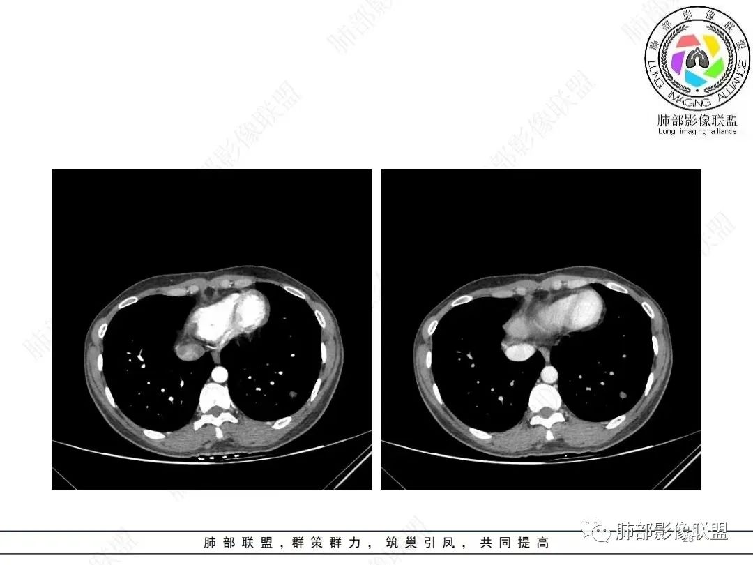 影像PPT - 【病例】年轻女性的肺结节-23 影像PPT - 【病例】年轻女性的肺结节-23