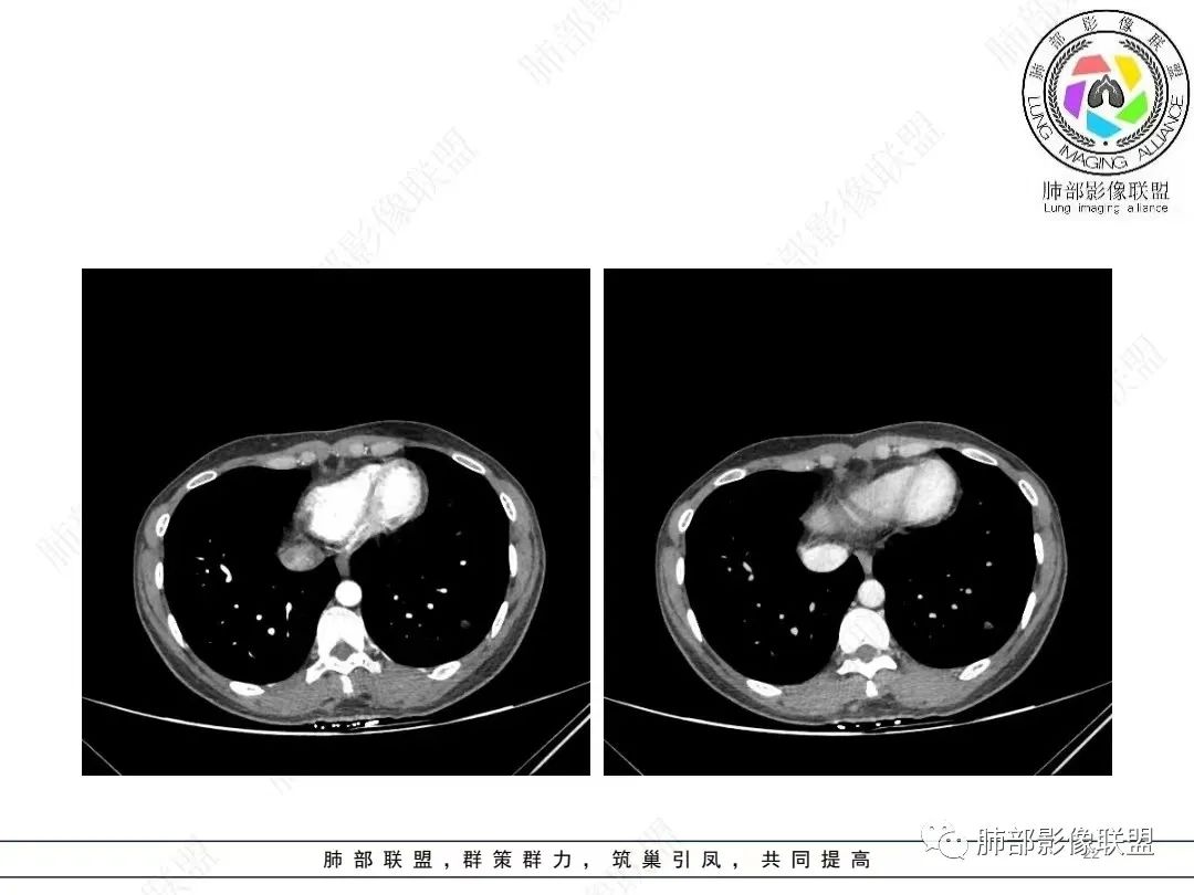 影像PPT - 【病例】年轻女性的肺结节-22 影像PPT - 【病例】年轻女性的肺结节-22
