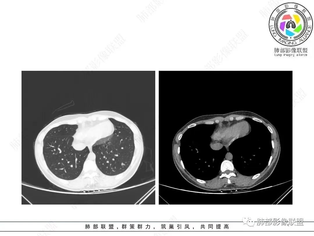 影像PPT - 【病例】年轻女性的肺结节-4 影像PPT - 【病例】年轻女性的肺结节-4