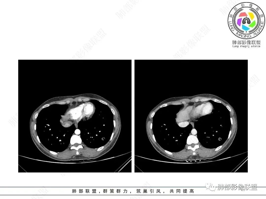 影像PPT - 【病例】年轻女性的肺结节-25 影像PPT - 【病例】年轻女性的肺结节-25
