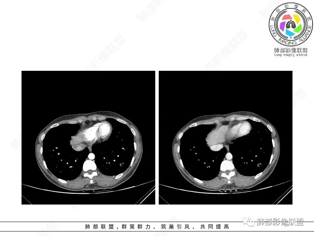 影像PPT - 【病例】年轻女性的肺结节-26 影像PPT - 【病例】年轻女性的肺结节-26