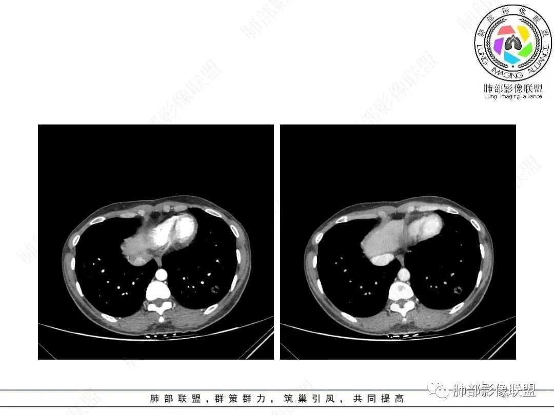 影像PPT - 【病例】年轻女性的肺结节-27 影像PPT - 【病例】年轻女性的肺结节-27