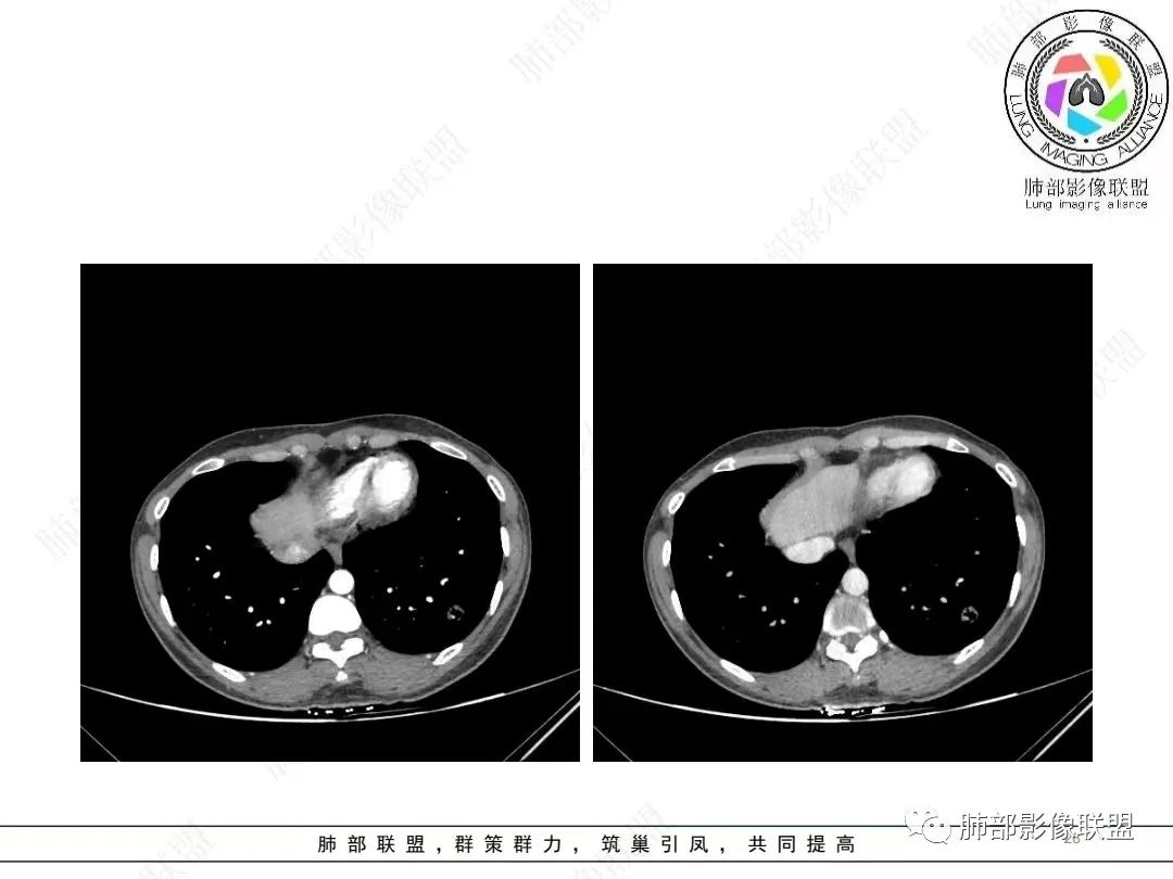影像PPT - 【病例】年轻女性的肺结节-28 影像PPT - 【病例】年轻女性的肺结节-28