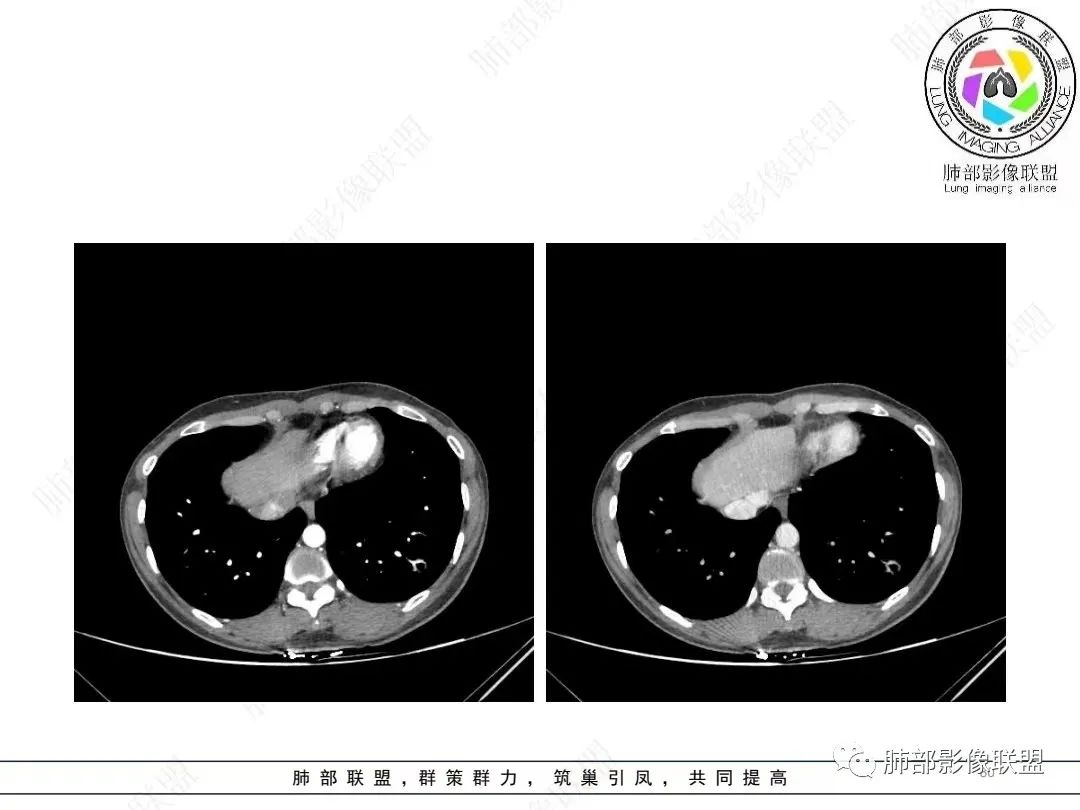 影像PPT - 【病例】年轻女性的肺结节-30 影像PPT - 【病例】年轻女性的肺结节-30