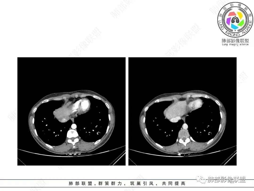 影像PPT - 【病例】年轻女性的肺结节-29 影像PPT - 【病例】年轻女性的肺结节-29