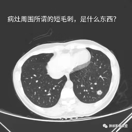 影像PPT - 【病例】年轻女性的肺结节-42 影像PPT - 【病例】年轻女性的肺结节-42