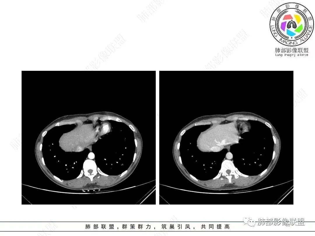 影像PPT - 【病例】年轻女性的肺结节-35 影像PPT - 【病例】年轻女性的肺结节-35