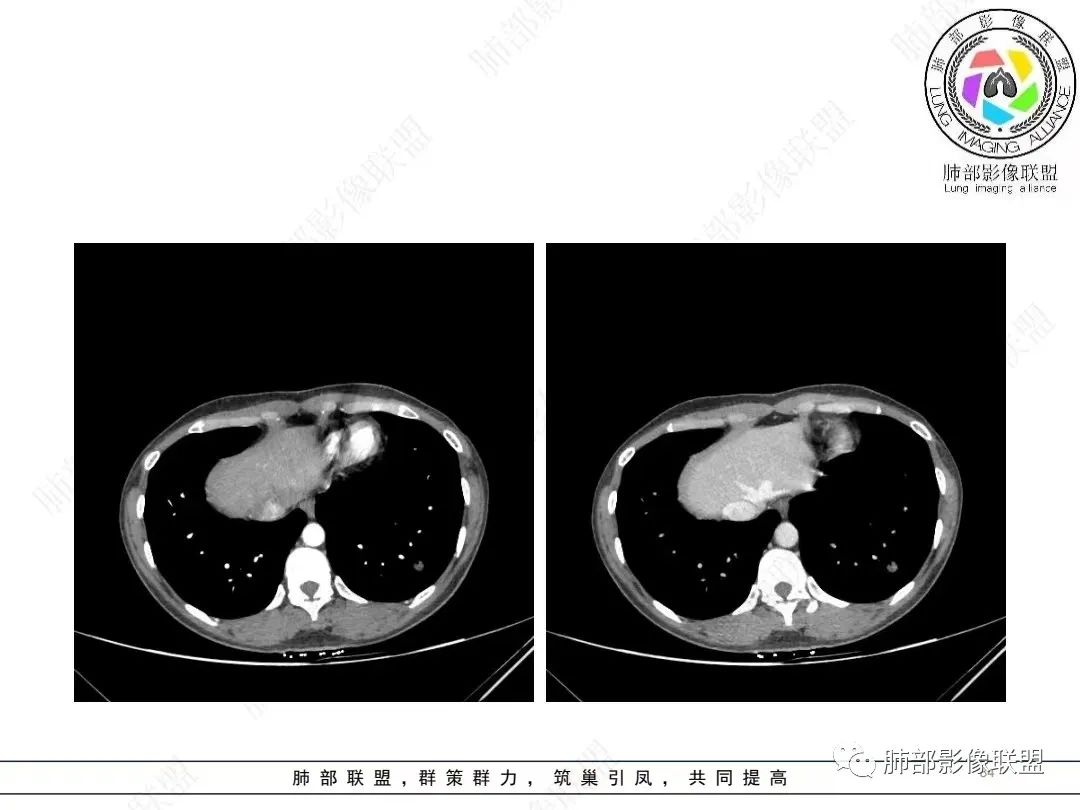 影像PPT - 【病例】年轻女性的肺结节-34 影像PPT - 【病例】年轻女性的肺结节-34