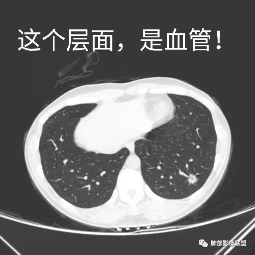 影像PPT - 【病例】年轻女性的肺结节-43 影像PPT - 【病例】年轻女性的肺结节-43