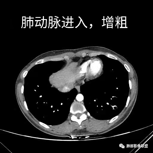 影像PPT - 【病例】年轻女性的肺结节-44 影像PPT - 【病例】年轻女性的肺结节-44