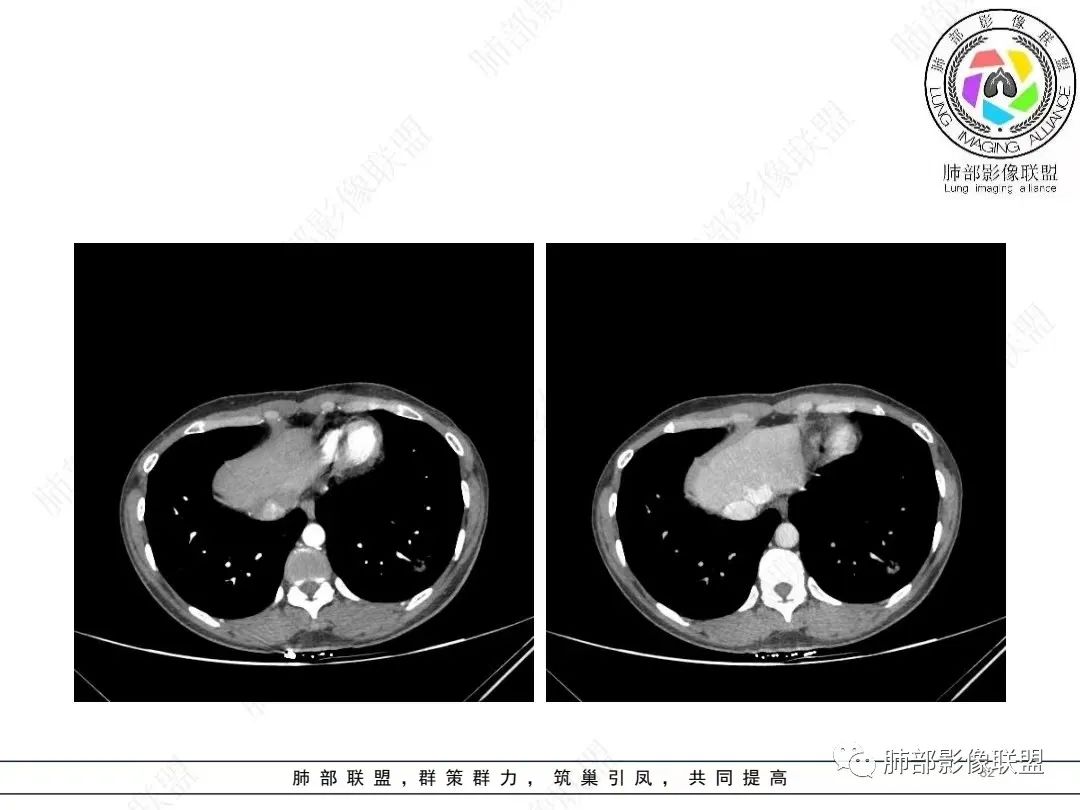 影像PPT - 【病例】年轻女性的肺结节-32 影像PPT - 【病例】年轻女性的肺结节-32