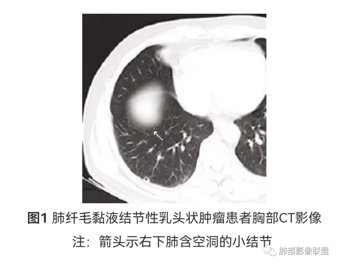 影像PPT - 【病例】年轻女性的肺结节-45