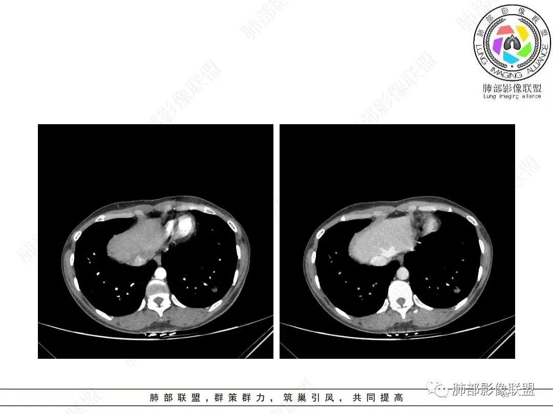 影像PPT - 【病例】年轻女性的肺结节-33 影像PPT - 【病例】年轻女性的肺结节-33