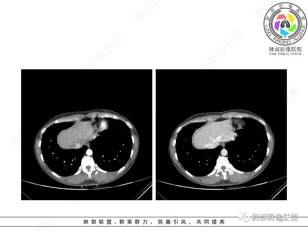 影像PPT - 【病例】年轻女性的肺结节-36 影像PPT - 【病例】年轻女性的肺结节-36