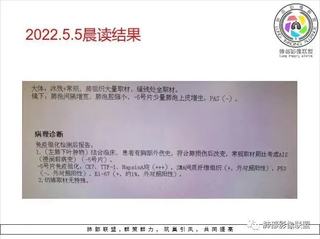 影像PPT - 【病例】年轻女性的肺结节-46 影像PPT - 【病例】年轻女性的肺结节-46