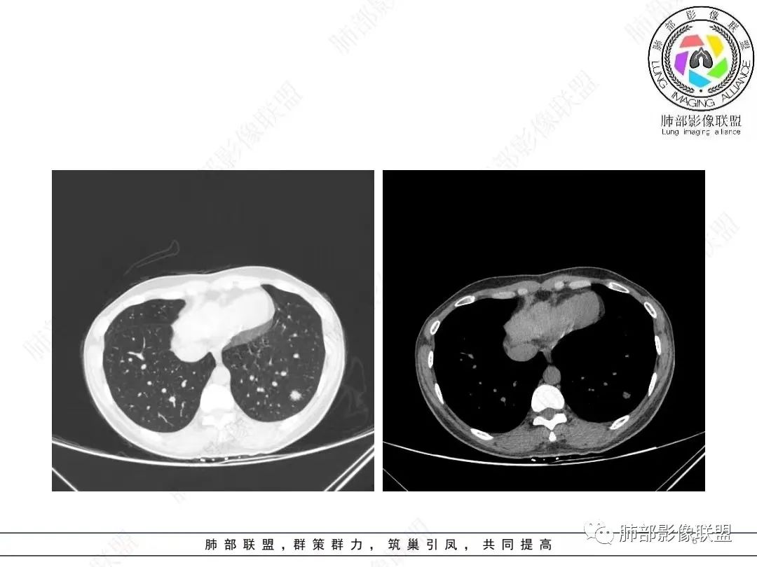 影像PPT - 【病例】年轻女性的肺结节-4 影像PPT - 【病例】年轻女性的肺结节-4