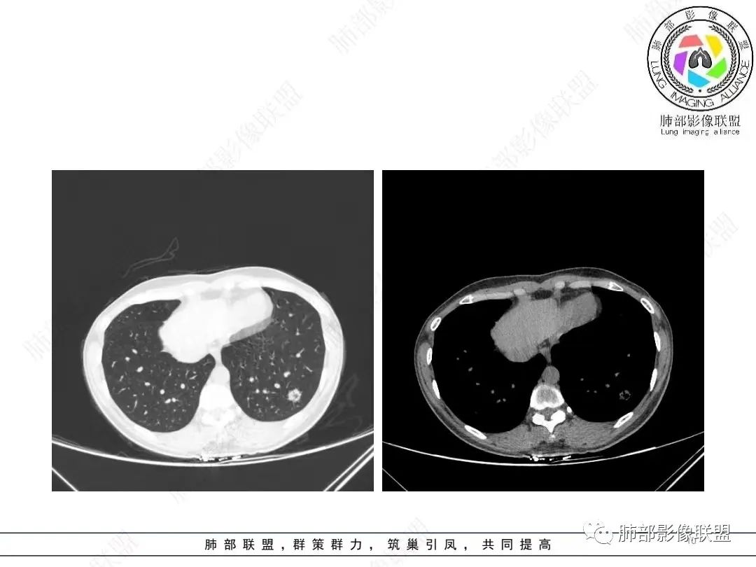 影像PPT - 【病例】年轻女性的肺结节-6 影像PPT - 【病例】年轻女性的肺结节-6