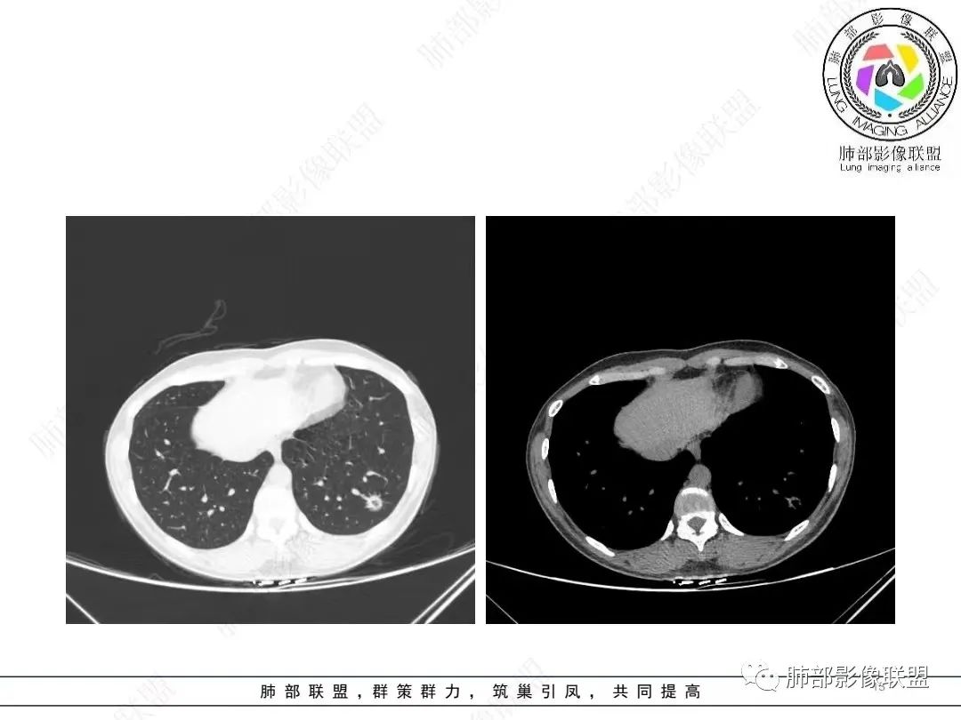 影像PPT - 【病例】年轻女性的肺结节-8 影像PPT - 【病例】年轻女性的肺结节-8