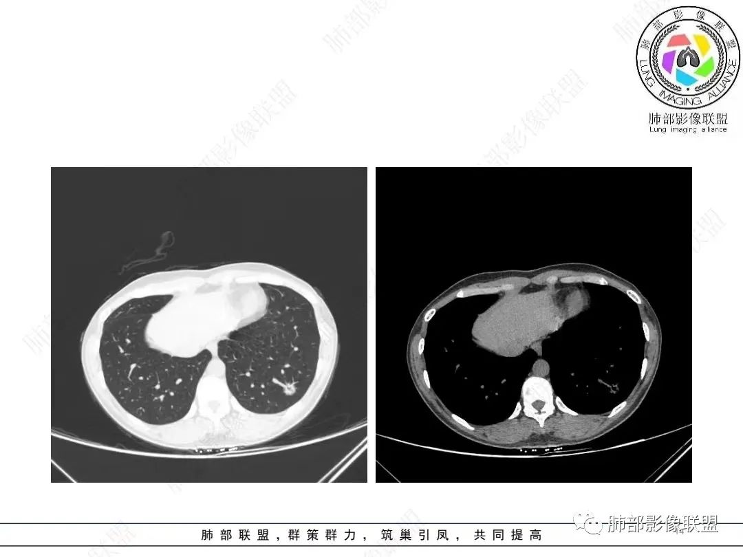 影像PPT - 【病例】年轻女性的肺结节-9 影像PPT - 【病例】年轻女性的肺结节-9