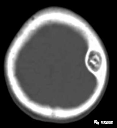 影像PPT - 【病例】棕色瘤1例CT影像表现-1 影像PPT - 【病例】棕色瘤1例CT影像表现-1