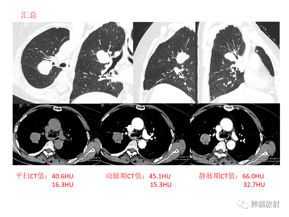 影像PPT - 【病例】肺肉瘤样癌2例CT影像-14