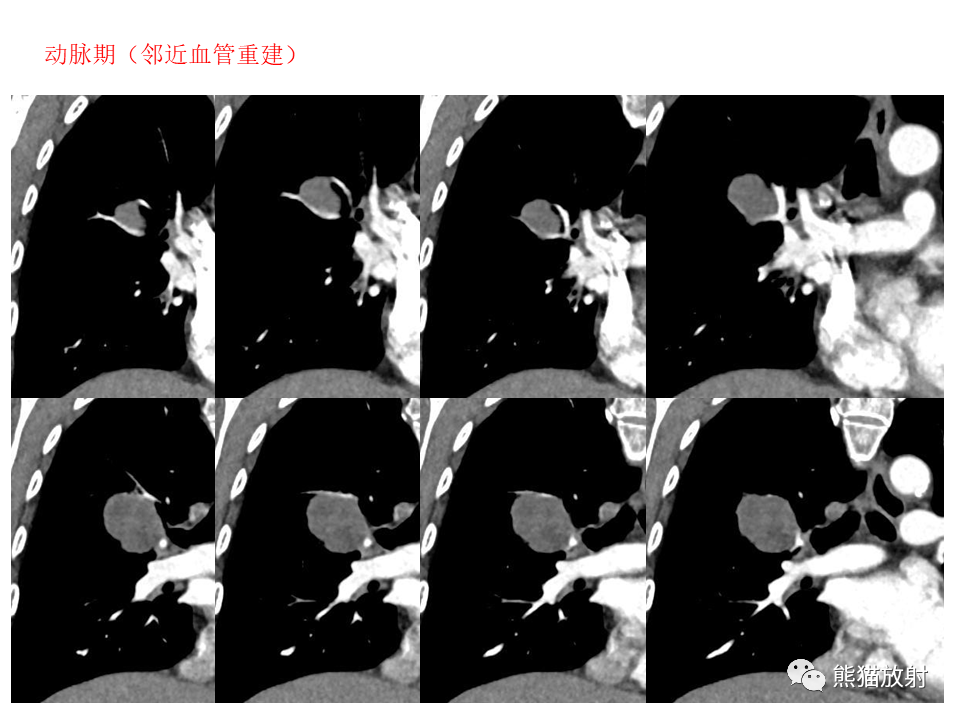 影像PPT - 【病例】肺肉瘤样癌2例CT影像-12