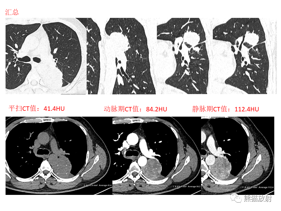 影像PPT - 【病例】肺肉瘤样癌2例CT影像-27
