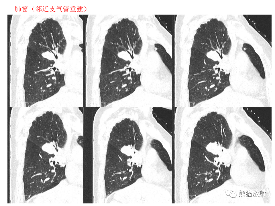影像PPT - 【病例】肺肉瘤样癌2例CT影像-8