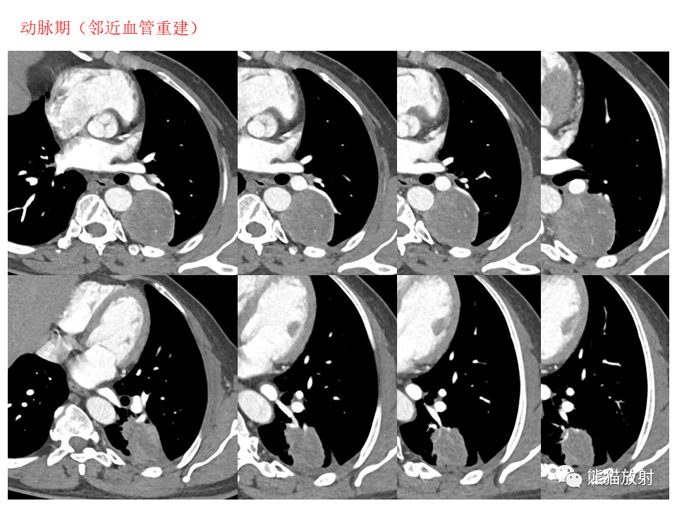 影像PPT - 【病例】肺肉瘤样癌2例CT影像-26