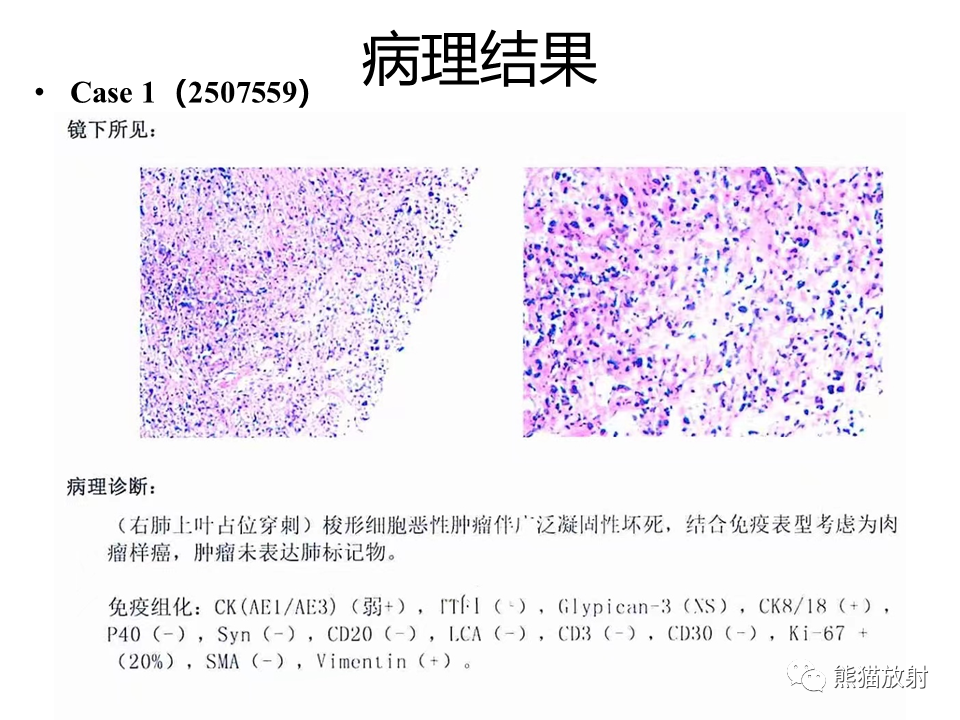 影像PPT - 【病例】肺肉瘤样癌2例CT影像-30
