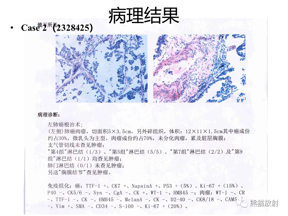 影像PPT - 【病例】肺肉瘤样癌2例CT影像-31